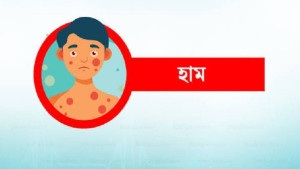 দেশে হামে আরও ৪ শিশুর মৃত্যু